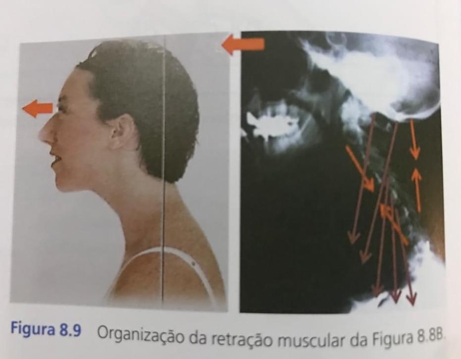 Retração Muscular na Cervical