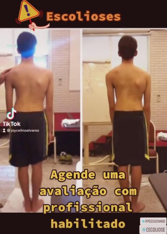 Tratamento Escoliose Juvenil RPG Souchard