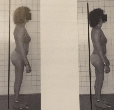 Adulta 42 anos com anteversão pélvica e lombalgia.